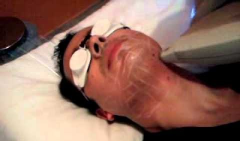 Epilation au laser de la barbe