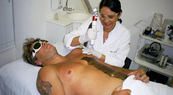 L'épilation masculine au laser