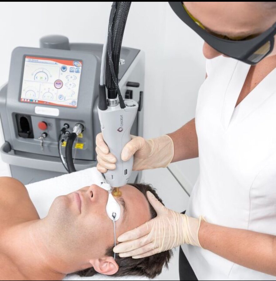 Epilation des sourcils au laser