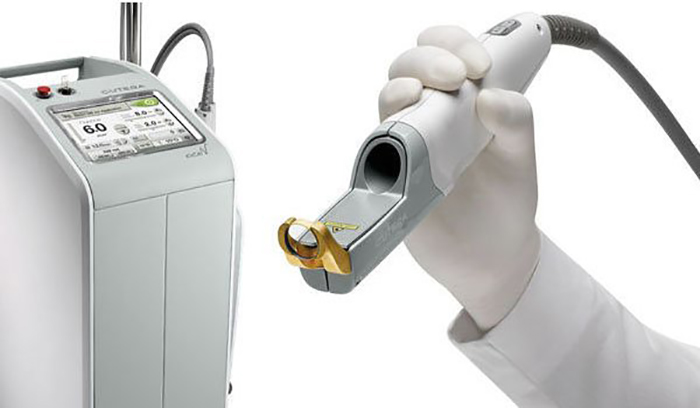 L'épilation laser nd:yag