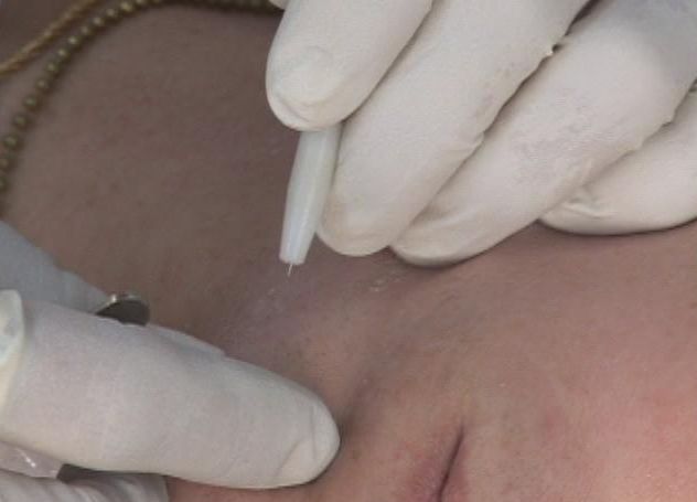 épilation électrolyse